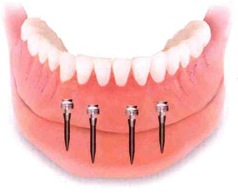 mini-implants-dentures